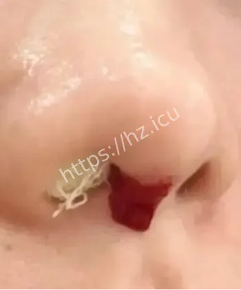 女子隆鼻玻尿酸鼻孔流出