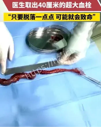 大爷静脉曲张长出巨型血栓